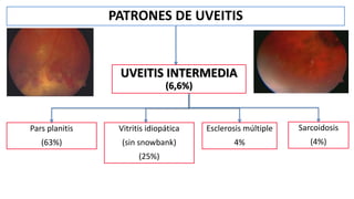 PATRONES DE UVEITIS
UVEITIS INTERMEDIA
(6,6%)
Pars planitis
(63%)
Vitritis idiopática
(sin snowbank)
(25%)
Esclerosis múltiple
4%
Sarcoidosis
(4%)
 