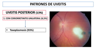 PATRONES DE UVEITIS
UVEITIS POSTERIOR (13%)
1. CON CORIORRETINITIS UNILATERAL (6,5%)
 Toxoplasmosis (93%)
 
