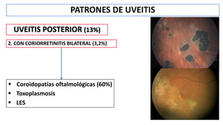 PATRONES DE UVEITIS
UVEITIS POSTERIOR (13%)
2. CON CORIORRETINITIS BILATERAL (3,2%)
 Coroidopatías oftalmológicas (60%)
 Toxoplasmosis
 LES
 
