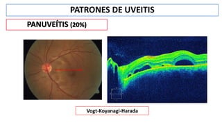 PATRONES DE UVEITIS
PANUVEÍTIS (20%)
Vogt-Koyanagi-Harada
 