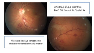 AVsc OD. 1 OI. 0.5 excéntrico
BMC. OD. Normal OI. Tyndall 3+
Vasculitis oclusiva componente
mixto con edema retiniano inferior
 