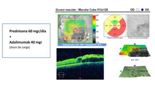 Prednisona 60 mgr/día
+
Adalimumab 40 mgr
(dosis de carga)
 