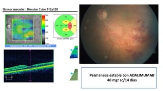 Permanece estable con ADALIMUMAB
40 mgr sc/14 días
 