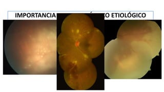 IMPORTANCIA DEL DIAGNÓSTICO ETIOLÓGICO
NO DAÑAR
Tratamiento con
inmunosupresores
Enfermedades
infecciosas o síndromes
mascarada
 