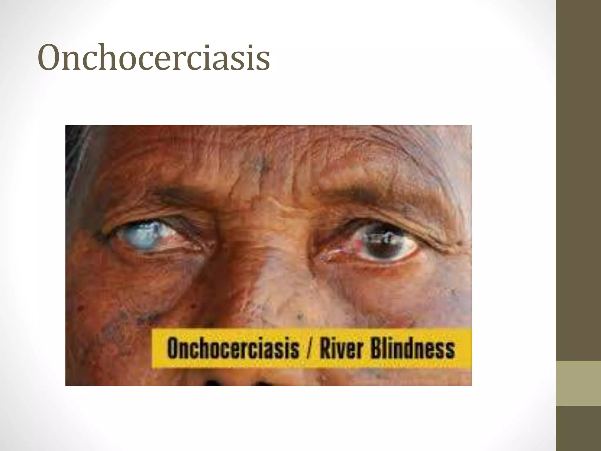 Onchocerciasis
 