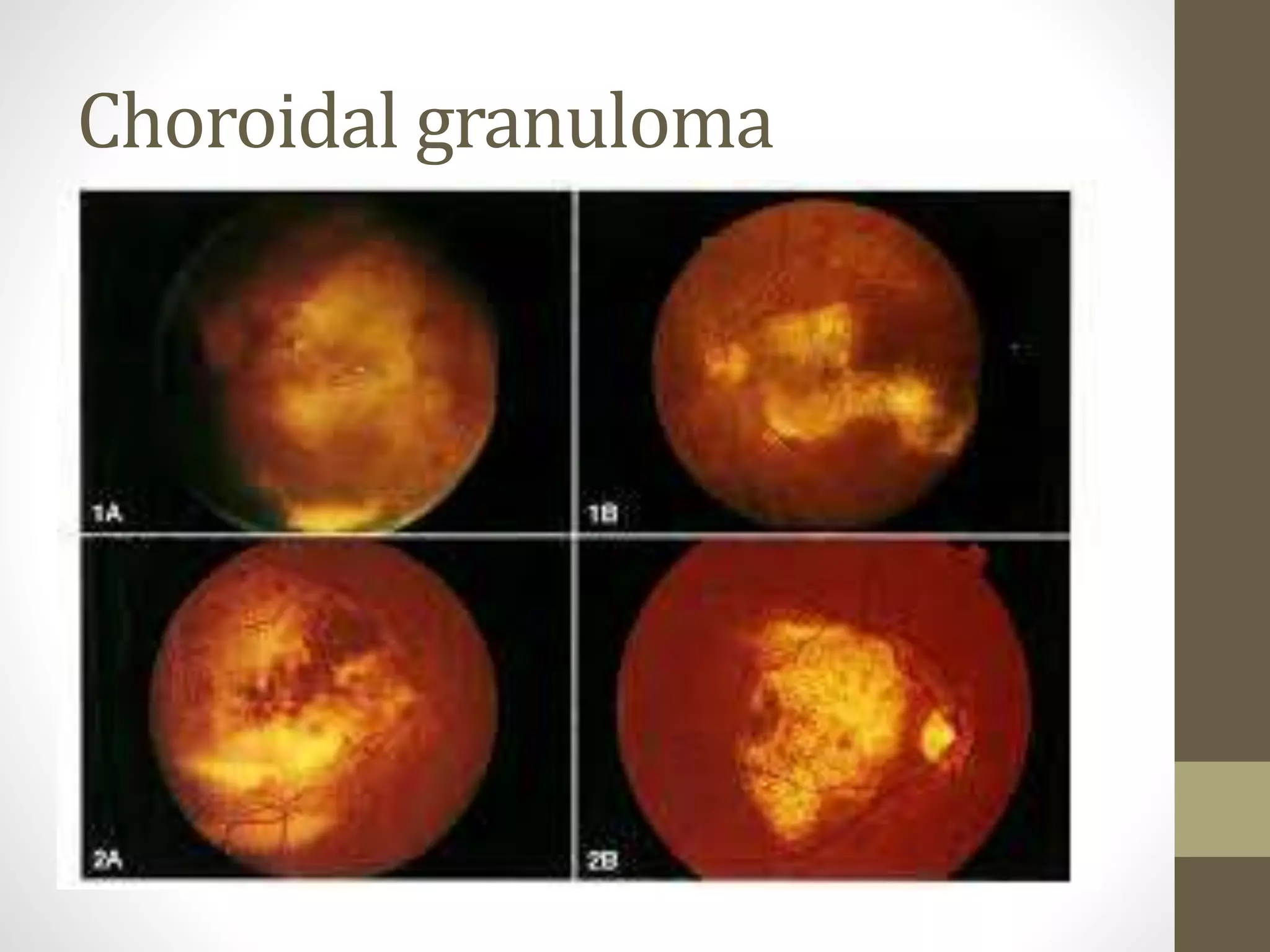 Choroidal granuloma
 