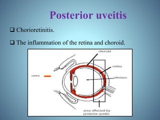 Posterior uveitis
 Chorioretinitis.
 The inflammation of the retina and choroid.
 
