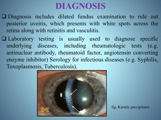 DIAGNOSIS
 Diagnosis includes dilated fundus examination to rule out
posterior uveitis, which presents with white spots across the
retina along with retinitis and vasculitis.
 Laboratory testing is usually used to diagnose specific
underlying diseases, including rheumatologic tests (e.g.
antinuclear antibody, rheumatoid factor, angiotensin converting
enzyme inhibitor) Serology for infectious diseases (e.g. Syphilis,
Toxoplasmosis, Tuberculosis).
fig. Keratic precipitates
 