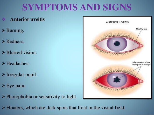 Uveitis Anterior Uveitis Anterior