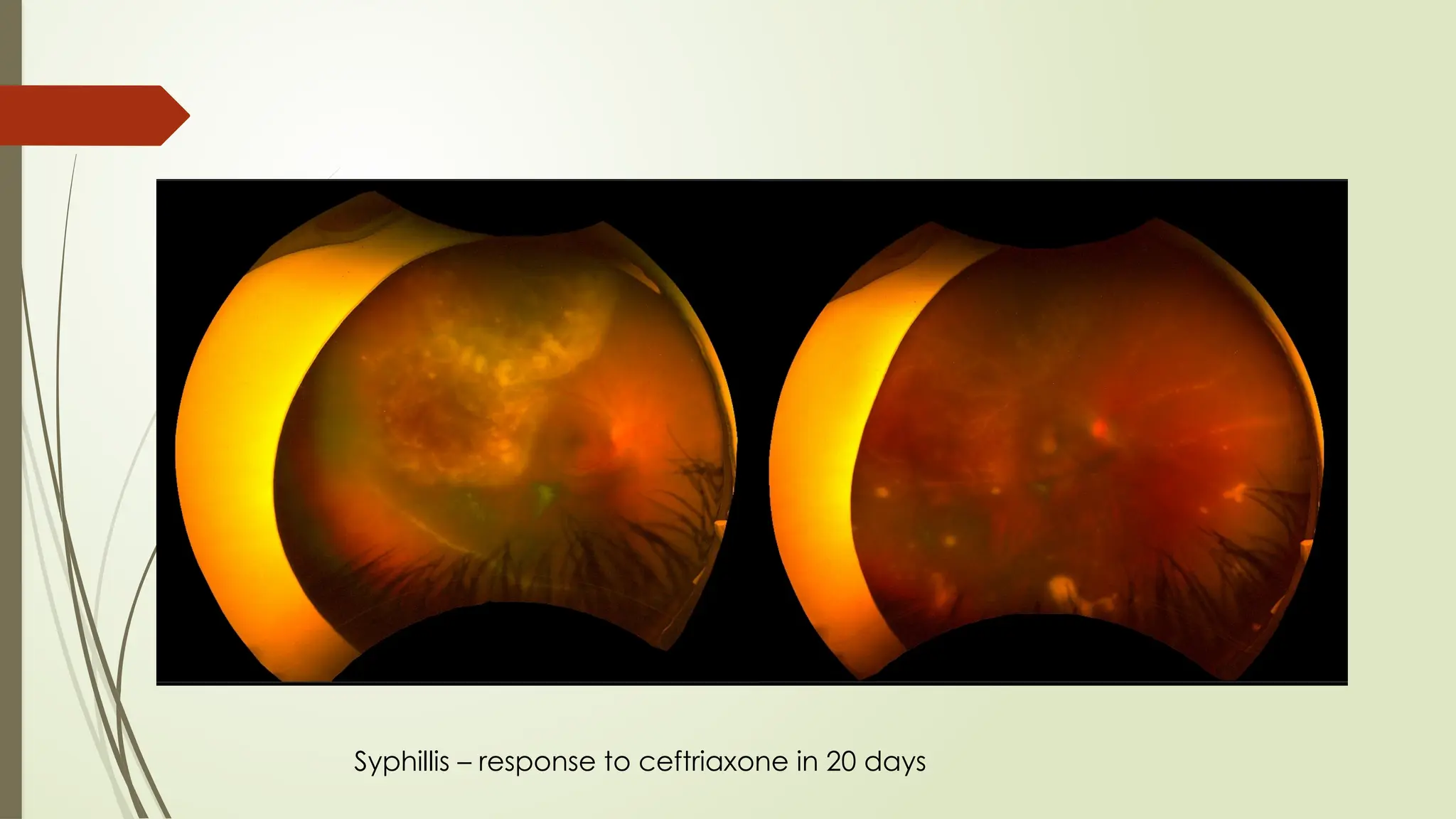 Syphillis – response to ceftriaxone in 20 days
 