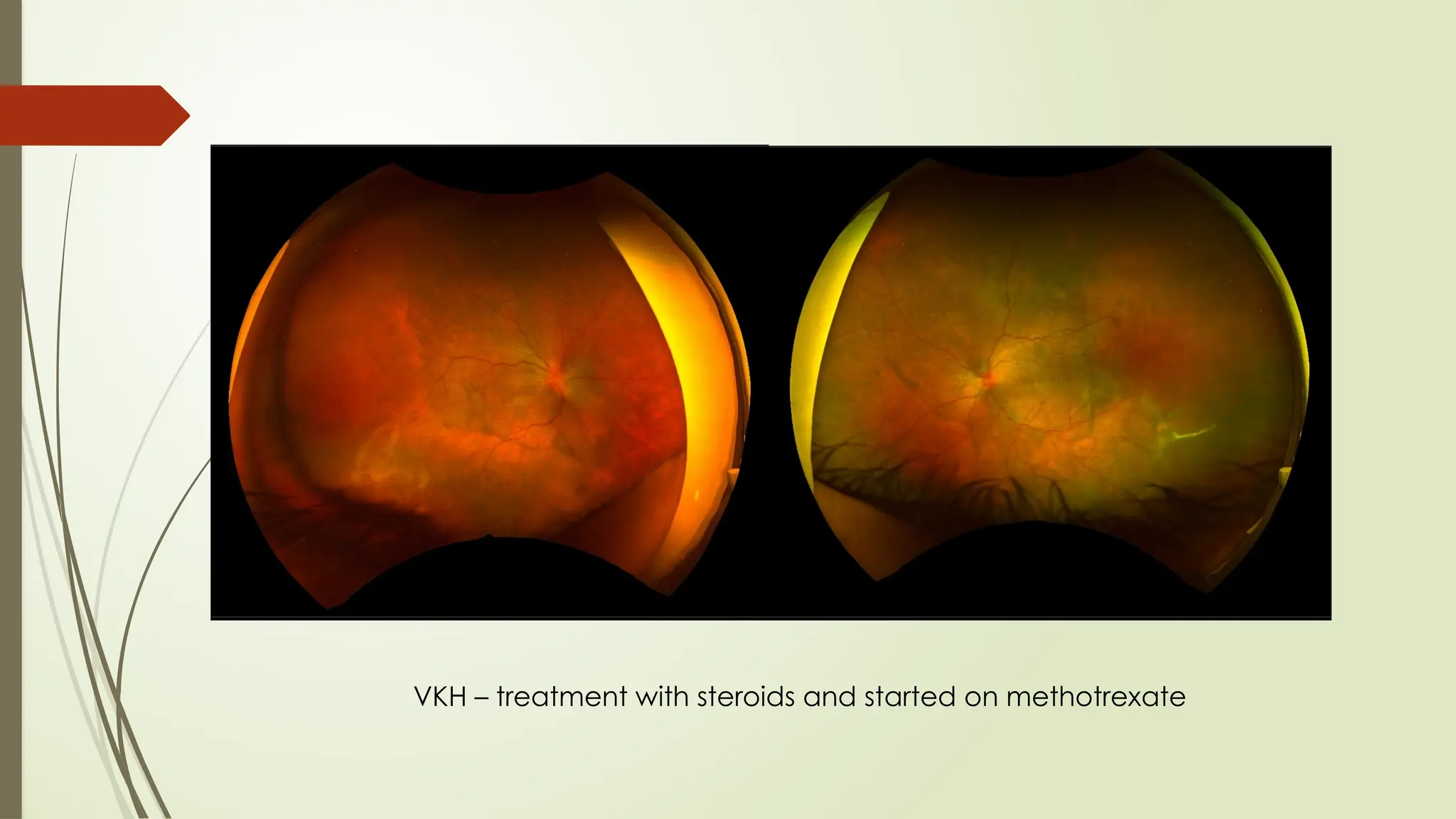 VKH – treatment with steroids and started on methotrexate
 