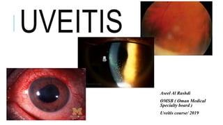 UVEITIS
Aseel Al Rashdi
OMSB ( Oman Medical
Specialty board )
Uveitis course/ 2019
 