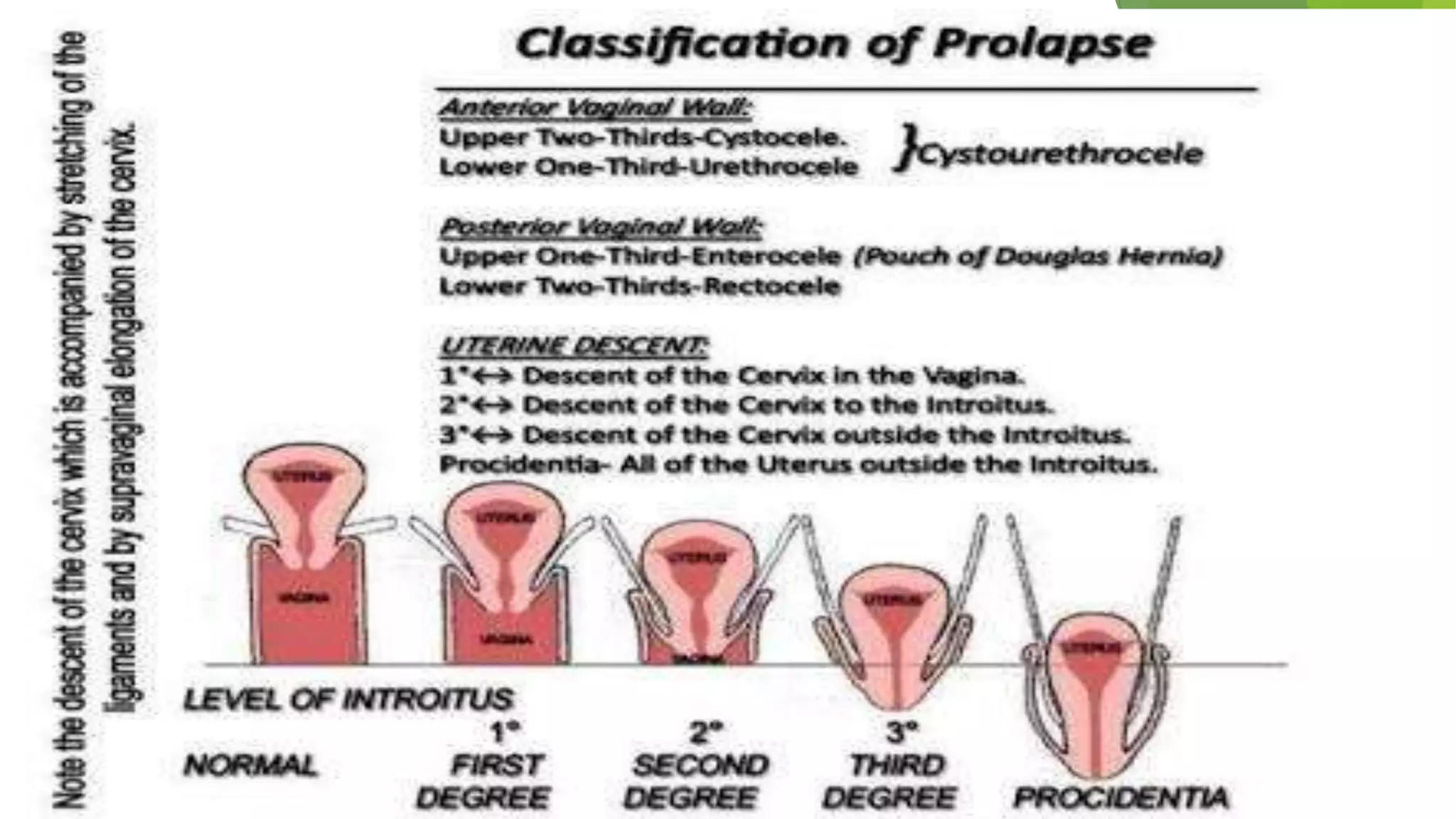 uv-prolapse-final-ppt