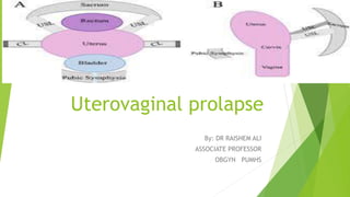 Uterovaginal prolapse
By: DR RAISHEM ALI
ASSOCIATE PROFESSOR
OBGYN PUMHS
 