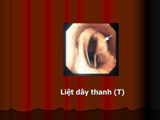 Liệt dây thanh (T)
 