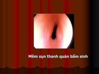 Mềm sụn thanh quản bẩm sinh
 