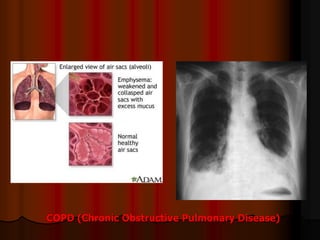 COPD (Chronic Obstructive Pulmonary Disease)
 