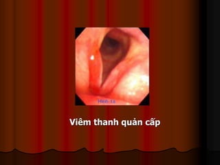Viêm thanh quản cấp
 