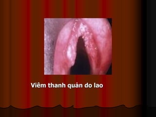 Viêm thanh quản do lao
 