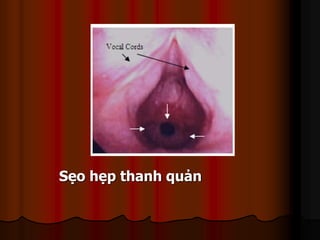 Sẹo hẹp thanh quản
 