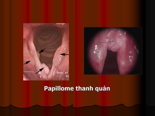 Papillome thanh quản
 