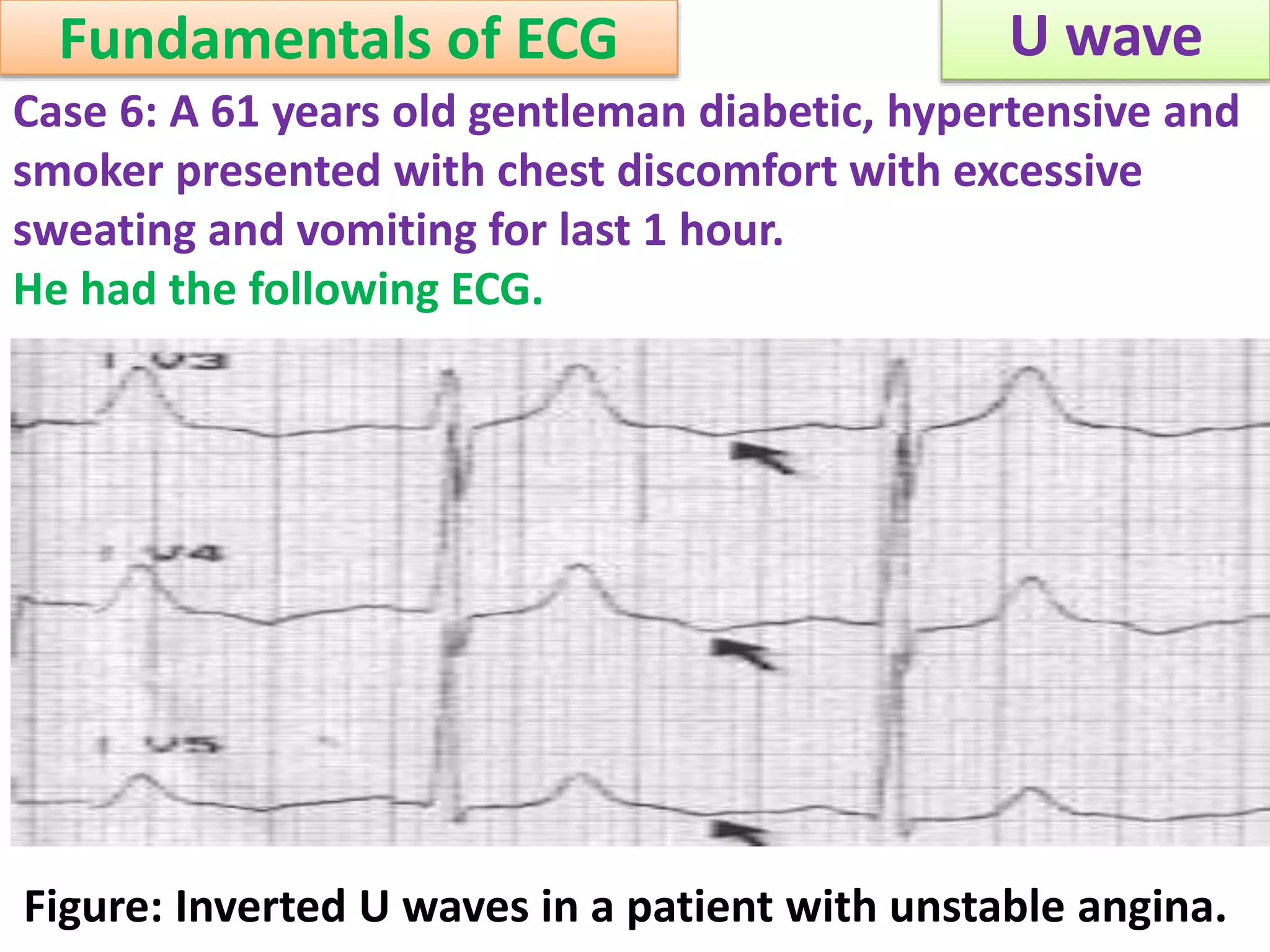 Approach to a patient with U wave in ECG | PPSX