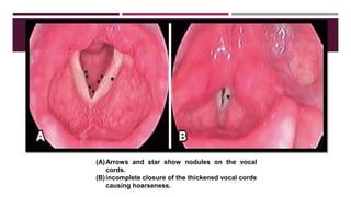 (A)Arrows and star show nodules on the vocal
cords.
(B)incomplete closure of the thickened vocal cords
causing hoarseness.
 