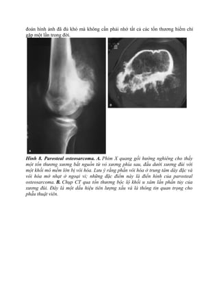 đoán hình ảnh đã đủ khó mà không cần phải nhớ tất cả các tổn thương hiếm chỉ
gặp một lần trong đời.
Hình 8. Parosteal osteosarcoma. A. Phim X quang gối hướng nghiêng cho thấy
một tổn thương xương bắt nguồn từ vỏ xương phía sau, đầu dưới xương đùi với
một khối mô mềm lớn bị vôi hóa. Lưu ý rằng phần vôi hóa ở trung tâm dày đặc và
vôi hóa mờ nhạt ở ngoại vi; những đặc điểm này là điển hình của parosteal
osteosarcoma. B. Chụp CT qua tổn thương bộc lộ khối u xâm lấn phần tủy của
xương đùi. Đây là một dấu hiệu tiên lượng xấu và là thông tin quan trọng cho
phẫu thuật viên.
 