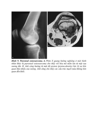 Hình 9. Parosteal osteosarcoma. A. Phim X quang hướng nghiêng ở một bệnh
nhân khác bị parosteal osteosarcoma cho thấy vôi hóa mô mềm lan từ mặt sau
xương đùi. B. Ảnh cộng hưởng từ mật độ proton (proton-density) bộc lộ sự liên
quan khá nhiều của xương. Ảnh cũng cho thấy các cấu trúc mạch máu không liên
quan đến khối.
 