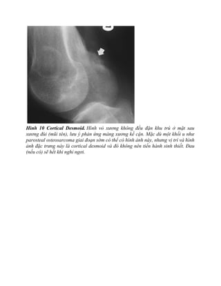 Hình 10 Cortical Desmoid. Hình vỏ xương không đều đặn khu trú ở mặt sau
xương đùi (mũi tên), lưu ý phản ứng màng xương kề cận. Mặc dù một khối u như
parosteal osteosarcoma giai đoạn sớm có thể có hình ảnh này, nhưng vị trí và hình
ảnh đặc trưng này là cortical desmoid và đó không nên tiến hành sinh thiết. Đau
(nếu có) sẽ hết khi nghỉ ngơi.
 