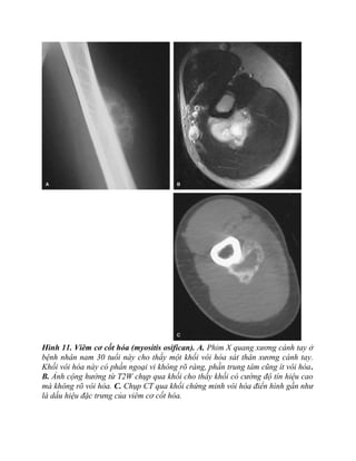 Hình 11. Viêm cơ cốt hóa (myositis osifican). A. Phim X quang xương cánh tay ở
bệnh nhân nam 30 tuổi này cho thấy một khối vôi hóa sát thân xương cánh tay.
Khối vôi hóa này có phần ngoại vi không rõ ràng, phần trung tâm cũng ít vôi hóa.
B. Ảnh cộng hưởng từ T2W chụp qua khối cho thấy khối có cường độ tín hiệu cao
mà không rõ vôi hóa. C. Chụp CT qua khối chứng minh vôi hóa điển hình gần như
là dấu hiệu đặc trưng của viêm cơ cốt hóa.
 