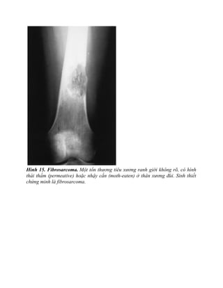 Hình 15. Fibrosarcoma. Một tổn thương tiêu xương ranh giới không rõ, có hình
thái thấm (permeative) hoặc nhậy cắn (moth-eaten) ở thân xương đùi. Sinh thiết
chứng minh là fibrosarcoma.
 
