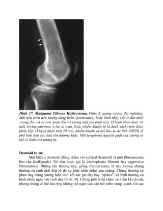 Hình 17. Malignant Fibrous Histiocytoma. Phim X quang xương đùi nghiêng:
Một tiến triển tiêu xương dạng thấm (permeative) hoặc hình nhậy cắn ở đầu dưới
xương đùi, có sự liên quan đến vở xương mặt sau (mũi tên). Ở bệnh nhân dưới 30
tuổi, Ewing sarcoma, u hạt ái toan, hoặc nhiễm khuẩn sẽ là danh sách chẩn đoán
phân biệt. Ở bệnh nhân trên 30 tuổi, nhiễm khuẩn và mô bào xơ ác tính (MFH) sẽ
phổ biến hơn các loại tổn thương khác. Một lymphoma nguyên phát của xương có
thể có hình ảnh tương tự.
Desmoid (u xơ)
Một khối u desmoid (đừng nhầm với cortical desmoid) là một fibrosarcoma
bán cấp (half-grade). Nó còn được gọi là desmoplastic fibroma hay aggressive
fibromatosis. Những tổn thương này, giống fibrosarcoma, là tiêu xương nhưng
thường có ranh giới khá rõ do sự phát triển chậm của chúng. Chúng thường có
phản ứng màng xương lành tính với các gai dày hay “spikes”, và bình thường có
hình nhiều ngăn với vách dày (hình 18). Chúng phát triển chậm và hiếm khi di căn,
nhưng chúng có thể lan rộng không thể ngăn cản vào mô mềm xung quanh với các
 