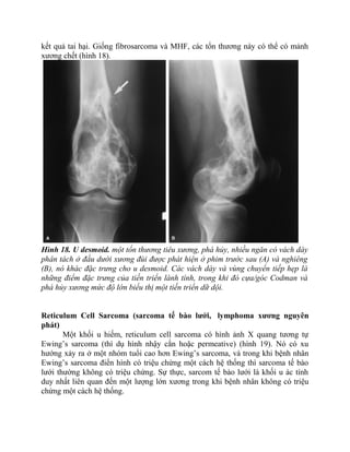 kết quả tai hại. Giống fibrosarcoma và MHF, các tổn thương này có thể có mảnh
xương chết (hình 18).
Hình 18. U desmoid. một tổn thương tiêu xương, phá hủy, nhiều ngăn có vách dày
phân tách ở đầu dưới xương đùi được phát hiện ở phim trước sau (A) và nghiêng
(B), nó khác đặc trưng cho u desmoid. Các vách dày và vùng chuyển tiếp hẹp là
những điểm đặc trưng của tiến triển lành tính, trong khi đó cựa/góc Codman và
phá hủy xương mức độ lớn biểu thị một tiến triển dữ dội.
Reticulum Cell Sarcoma (sarcoma tế bào lưới, lymphoma xương nguyên
phát)
Một khối u hiếm, reticulum cell sarcoma có hình ảnh X quang tương tự
Ewing’s sarcoma (thí dụ hình nhậy cắn hoặc permeative) (hình 19). Nó có xu
hướng xảy ra ở một nhóm tuổi cao hơn Ewing’s sarcoma, và trong khi bệnh nhân
Ewing’s sarcoma điển hình có triệu chứng một cách hệ thống thì sarcoma tế bào
lưới thường không có triệu chứng. Sự thực, sarcom tế bào lưới là khối u ác tính
duy nhất liên quan đến một lượng lớn xương trong khi bệnh nhân không có triệu
chứng một cách hệ thống.
 