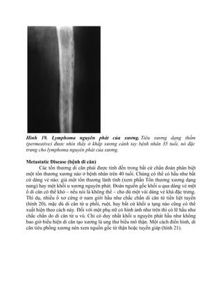 Hình 19. Lymphoma nguyên phát của xương. Tiêu xương dạng thấm
(permeative) được nhìn thấy ở khắp xương cánh tay bệnh nhân 35 tuổi, nó đặc
trưng cho lymphoma nguyên phát của xương.
Metastatic Disease (bệnh di căn)
Các tổn thương di căn phải được tính đến trong bất cứ chẩn đoán phân biệt
một tổn thương xương nào ở bệnh nhân trên 40 tuổi. Chúng có thể có hầu như bất
cứ dáng vẻ nào: giả một tổn thương lành tính (xem phần Tổn thương xương dạng
nang) hay một khối u xương nguyên phát. Đoán nguồn gốc khối u qua dáng vẻ một
ổ di căn có thể khó – nếu nói là không thể – cho dù một vài dáng vẻ khá đặc trưng.
Thí dụ, nhiều ổ xơ cứng ở nam giới hầu như chắc chắn di căn từ tiền liệt tuyến
(hình 20), mặc dù di căn từ u phổi, ruột, hay bất cứ khối u tạng nào cũng có thể
xuất hiện theo cách này. Đối với một phụ nữ có hình ảnh như trên thì có lẽ hầu như
chắc chắn do di căn từ u vú. Chỉ có duy nhất khối u nguyên phát hầu như không
bao giờ biểu hiện di căn tạo xương là ung thư biểu mô thận. Một cách điển hình, di
căn tiêu phồng xương nên xem nguồn gốc từ thận hoặc tuyến giáp (hình 21).
 