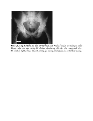 Hình 20. Ung thư biểu mô tiền liệt tuyến di căn. Nhiều ổ di căn tạo xương ở khắp
khung chậu, đầu trên xương đùi phải có tổn thương phá hủy, tiêu xương (mũi tên).
Di căn tiền liệt tuyến có khuynh hướng tạo xương, nhưng đôi khi có thể tiêu xương.
 