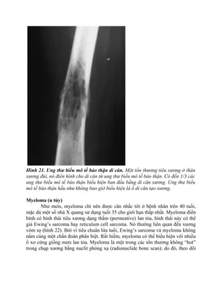 Hình 21. Ung thư biểu mô tế bào thận di căn. Một tổn thương tiêu xương ở thân
xương đùi, nó điển hình cho di căn từ ung thư biểu mô tế bào thận. Có đến 1/3 các
ung thư biểu mô tế bào thận biểu hiện ban đầu bằng di căn xương. Ung thư biểu
mô tế bào thận hầu như không bao giờ biểu hiện là ổ di căn tạo xương.
Myeloma (u tủy)
Như mets, myeloma chỉ nên được cân nhắc tới ở bệnh nhân trên 40 tuổi,
mặc dù một số nhà X quang sử dụng tuổi 35 cho giới hạn thấp nhất. Myeloma điển
hình có hình thái tiêu xương dạng thấm (permeative) lan tỏa, hình thái này có thể
giả Ewing’s sarcoma hay reticulum cell sarcoma. Nó thường liên quan đến xương
vòm sọ (hình 22). Bởi vì tiêu chuẩn lứa tuổi, Ewing’s sarcoma và myeloma không
nằm cùng một chẩn đoán phân biệt. Rất hiếm, myeloma có thể biểu hiện với nhiều
ổ xơ cứng giống mets lan tỏa. Myeloma là một trong các tổn thương không “hot”
trong chụp xương bằng nuclit phóng xạ (radionuclide bone scan); do đó, theo dõi
 