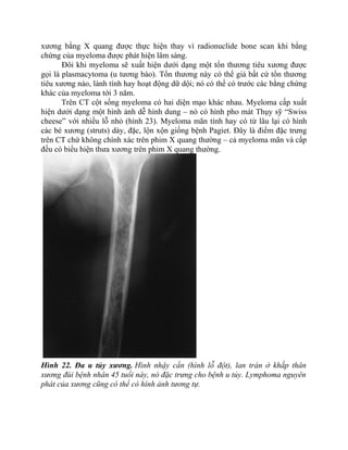 xương bằng X quang được thực hiện thay vì radionuclide bone scan khi bằng
chứng của myeloma được phát hiện lâm sàng.
Đôi khi myeloma sẽ xuất hiện dưới dạng một tổn thương tiêu xương được
gọi là plasmacytoma (u tương bào). Tổn thương này có thể giả bất cứ tổn thương
tiêu xương nào, lành tính hay hoạt động dữ dội; nó có thể có trước các bằng chứng
khác của myeloma tới 3 năm.
Trên CT cột sống myeloma có hai diện mạo khác nhau. Myeloma cấp xuất
hiện dưới dạng một hình ảnh dễ hình dung – nó có hình pho mát Thụy sỹ “Swiss
cheese” với nhiều lỗ nhỏ (hình 23). Myeloma mãn tính hay có từ lâu lại có hình
các bè xương (struts) dày, đặc, lộn xộn giống bệnh Pagiet. Đây là điểm đặc trưng
trên CT chứ không chính xác trên phim X quang thường – cả myeloma mãn và cấp
đều có biểu hiện thưa xương trên phim X quang thường.
Hình 22. Đa u tủy xương. Hình nhậy cắn (hình lỗ đột), lan tràn ở khắp thân
xương đùi bệnh nhân 45 tuổi này, nó đặc trưng cho bệnh u tủy. Lymphoma nguyên
phát của xương cũng có thể có hình ảnh tương tự.
 