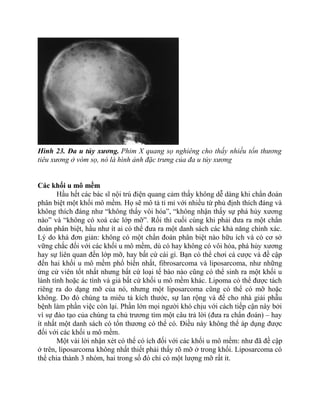 Hình 23. Đa u tủy xương. Phim X quang sọ nghiêng cho thấy nhiều tổn thương
tiêu xương ở vòm sọ, nó là hình ảnh đặc trưng của đa u tủy xương
Các khối u mô mềm
Hầu hết các bác sĩ nội trú điện quang cảm thấy không dễ dàng khi chẩn đoán
phân biệt một khối mô mềm. Họ sẽ mô tả tỉ mỉ với nhiều từ phủ định thích đáng và
không thích đáng như “không thấy vôi hóa”, “không nhận thấy sự phá hủy xương
nào” và “không có xoá các lớp mỡ”. Rồi thì cuối cùng khi phải đưa ra một chẩn
đoán phân biệt, hầu như ít ai có thể đưa ra một danh sách các khả năng chính xác.
Lý do khá đơn giản: không có một chẩn đoán phân biệt nào hữu ích và có cơ sở
vững chắc đối với các khối u mô mềm, dù có hay không có vôi hóa, phá hủy xương
hay sự liên quan đến lớp mỡ, hay bất cứ cái gì. Bạn có thể chơi cá cược và đề cập
đến hai khối u mô mềm phổ biến nhất, fibrosarcoma và liposarcoma, như những
ứng cử viên tốt nhất nhưng bất cứ loại tế bào nào cũng có thể sinh ra một khối u
lành tính hoặc ác tính và giả bất cứ khối u mô mềm khác. Lipoma có thể được tách
riêng ra do dạng mỡ của nó, nhưng một liposarcoma cũng có thể có mỡ hoặc
không. Do đó chúng ta miêu tả kích thước, sự lan rộng và để cho nhà giải phẫu
bệnh làm phần việc còn lại. Phần lớn mọi người khó chịu với cách tiếp cận này bởi
vì sự đào tạo của chúng ta chủ trương tìm một câu trả lời (đưa ra chẩn đoán) – hay
ít nhất một danh sách có tổn thương có thể có. Điều này không thể áp dụng được
đối với các khối u mô mềm.
Một vài lời nhận xét có thể có ích đối với các khối u mô mềm: như đã đề cập
ở trên, liposarcoma không nhất thiết phải thấy rõ mỡ ở trong khối. Liposarcoma có
thể chia thành 3 nhóm, hai trong số đó chỉ có một lượng mỡ rất ít.
 