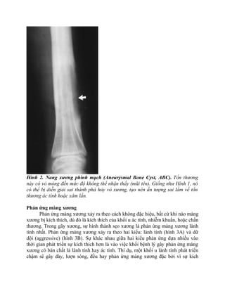 Hình 2. Nang xương phình mạch (Aneurysmal Bone Cyst, ABC). Tổn thương
này có vỏ mỏng đến mức độ không thể nhận thấy (mũi tên). Giống như Hình 1, nó
có thể bị diễn giải sai thành phá hủy vỏ xương, tạo nên ấn tượng sai lầm về tổn
thương ác tính hoặc xâm lấn.
Phản ứng màng xương
Phản ứng màng xương xảy ra theo cách không đặc hiệu, bất cứ khi nào màng
xương bị kích thích, dù đó là kích thích của khối u ác tính, nhiễm khuẩn, hoặc chấn
thương. Trong gãy xương, sự hình thành sẹo xương là phản ứng màng xương lành
tính nhất. Phản ứng màng xương xảy ra theo hai kiểu: lành tính (hình 3A) và dữ
dội (aggressive) (hình 3B). Sự khác nhau giữa hai kiểu phản ứng dựa nhiều vào
thời gian phát triển sự kích thích hơn là vào việc khối bệnh lý gây phản ứng màng
xương có bản chất là lành tính hay ác tính. Thí dụ, một khối u lành tính phát triển
chậm sẽ gây dày, lượn sóng, đều hay phản ứng màng xương đặc bởi vì sự kích
 