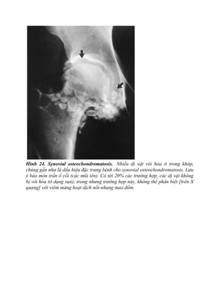 Hình 24. Synovial osteochondromatosis. Nhiều dị vật vôi hóa ở trong khớp,
chúng gần như là dấu hiệu đặc trưng bệnh cho synovial osteochondromatosis. Lưu
ý bào mòn trần ổ cối (các mũi tên). Có tới 20% các trường hợp, các dị vật không
bị vôi hóa (ở dạng sụn); trong nhưng trường hợp này, không thể phân biệt [trên X
quang] với viêm màng hoạt dịch nốt-nhung mao đốm.
 