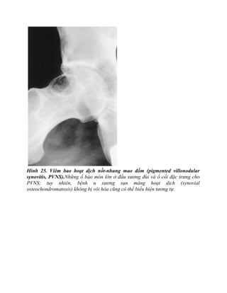 Hình 25. Viêm bao hoạt dịch nốt-nhung mao đốm (pigmented villonodular
synovitis, PVNS).Những ổ bào mòn lớn ở đầu xương đùi và ổ cối đặc trưng cho
PVNS; tuy nhiên, bệnh u xương sụn màng hoạt dịch (synovial
osteochondromatosis) không bị vôi hóa cũng có thể biểu hiện tương tự.
 