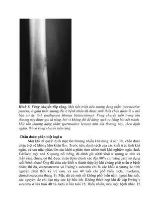 Hình 5. Vùng chuyển tiếp rộng. Một tiến triển tiêu xương dạng thấm (permeative
pattern) ở giữa thân xương đùi ở bệnh nhân đã được sinh thiết chẩn đoán là u mô
bào xơ ác tính (malignant fibrous histiocytoma). Vùng chuyển tiếp trong tổn
thương này được gọi là rộng, bởi vì không thể dễ dàng vạch ra bằng bút nét mảnh.
Một tổn thương dạng thấm (permeative lesion) như tổn thương này, theo định
nghĩa, thì có vùng chuyển tiếp rộng.
Chẩn đoán phân biệt loại u
Một khi đã quyết định một tổn thương nhiều khả năng là ác tính, chẩn đoán
phân biệt sẽ không khó khăn lắm. Trước tiên, danh sách của các khối u ác tính khá
ngắn, và sau nữa, phần lớn các khối u phân theo nhóm tuổi khá nghiêm ngặt. Jack
Edeiken, một nhà X quang nổi tiếng, đã đánh giá 4000 khối u xương ác tính và
thấy rằng chúng có thể được chẩn đoán chính xác đến 80% chỉ bằng cách sử dụng
tuổi bệnh nhân! Ông đã chia các khối u thành thập kỷ khi chúng phát triển ở bệnh
nhân; thí dụ, osteosarcoma và Ewing’s sarcoma chỉ là các khối u xương ác tính
nguyên phát thời kỳ trẻ con, và sau 40 tuổi chỉ phổ biến mets, myeloma,
chondrosarcoma (bảng 1). Mặc dù có một số không phổ biến nằm ngoài lứa tuổi,
các nguyên tắc chỉ đạo này cực kỳ hữu ích. Không thích hợp khi đề cập Ewing’s
sarcoma ở lứa tuổi 40 và mets ở lứa tuổi 15. Hiển nhiên, nếu một bệnh nhân 15
 