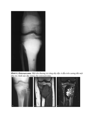 Hình 6. Osteosarcoma. Một tổn thương xơ cứng dày đặc ở đầu trên xương đùi một
đứa trẻ, hình này đặc trưng cho osteosarcoma.
 