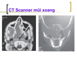 CT Scanner mũi xoang
 