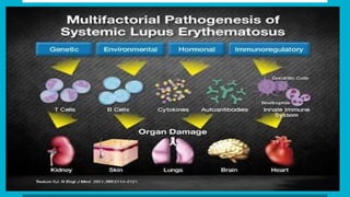 Systemic lupus erythematosis diagnosis and treatment | PPTX
