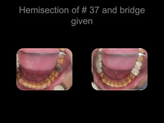 Amelogenesis imperfecta case | PPT