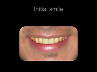 Initial smile
 