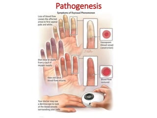 Pathogenesis
 