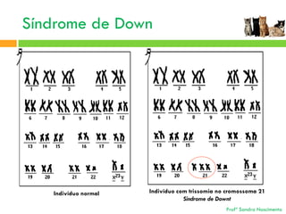 Síndrome de Down

Indivíduo normal

Indivíduo com trissomia no cromossoma 21
Sindrome de Downt
Profª Sandra Nascimento

 